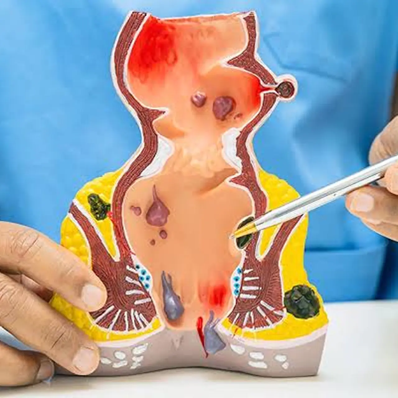 Laser Pilonidal Sinus Surgery